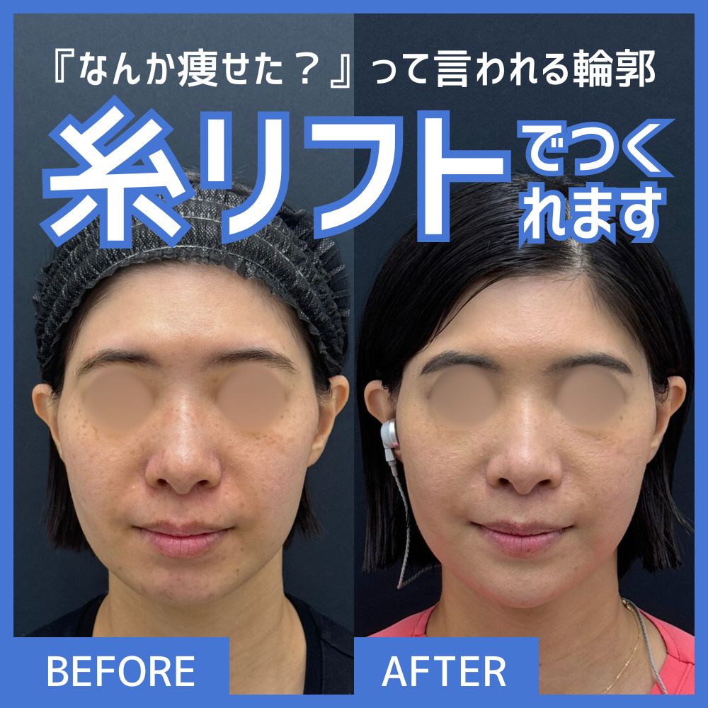 新潟の糸リフトは出口院長にお任せ｜症例写真でわかる小顔＆若返り施術